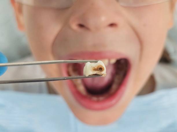 Best Knocked-Out Tooth (Avulsed Tooth) Treatment in Sidney, IL